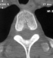 Капиллярная гемангиома