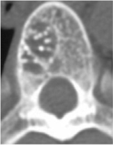 Смешанная гемангиома