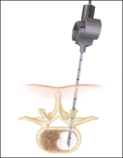 Вертебропластика