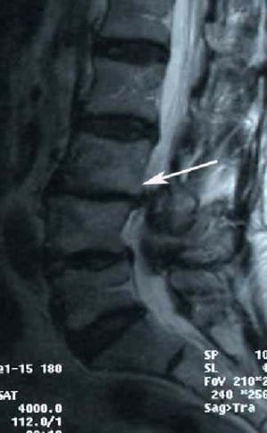 Рис.4. МРТ поясничного отдела позвоночника. Ретролистез L3  позвонка. Стрелкой указано  смещение L3 позвонка кзади. 