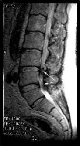 Рис. 1. МРТ поясничного отдела позвоночника в боковой проекции. Стрелками указан стеноз позвоночного канала на уровне L3-L4, L4-L5 позвонков.