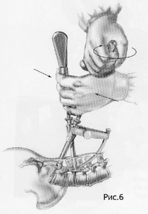 Рис.7-6. Схема миниинвазивной технологии транспедикулярной фиксации позвоночника.  Выполняется фиксация стержня с транспедикулярным винтом при помощи гайки.