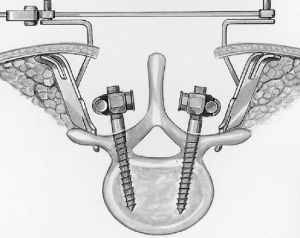 Рис. 5a. Схема введения винтов через дужки позвонка при транспедикулярной фиксации позвоночника.