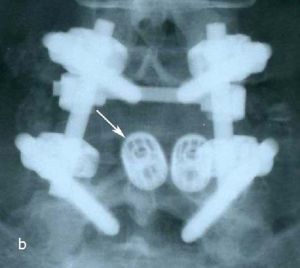 Рис. 6b. Рентгенограмма поясничного отдела позвоночника в боковой (а) и прямой (b) проекции после операции транспедикулярной фиксации L4-L5 позвонков. Стрелкой указаны 2 титановых цилиндрических кейджа. 