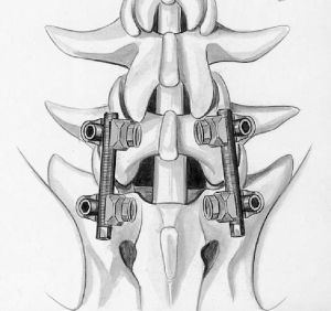 Рис. 5b. Схема транспедикулярной фиксации L4-L5 позвонков титановой конструкцией. Окончательный вид конструкции в сборе (вид сверху).