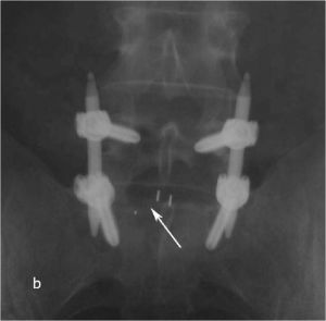 Рис. 10 b. Ренгенограмма поясничного отдела позвоночника в боковой (a) и прямой (b) проекции. Транспедикулярная фиксация L5-S1 позвонков титановой конструкцией канюлированными винтами, межтеловая фиксация позвонков кейджем из PEEK-керамики. Стрелкой указано положение ренген–негативного кейджа, видны титановые метки кейджа.