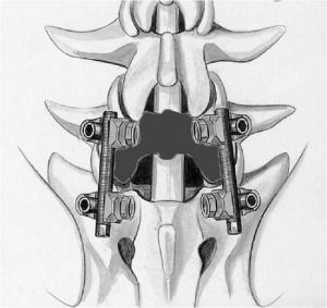 Рис.6б. Схема транспедикулярной фиксации L5-S1 позвонков титановой конструкцией. Окончательный вид конструкции  в сборе (вид сверху). Серым цветом указана зона удаления  дужки L5 позвонка.