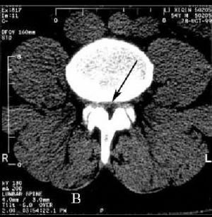 Рис.2В. КТ поясничного отдела позвоночника на уровне L4-L5 позвонков.Стрелкой на обоих снимках указано сужение позвоночного канала на уровне L4-L5 позвонков. 
