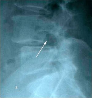 Рис. 8а. Рентгенограмма поясничного отдела позвоночника в боковой (а) и прямой (b) проекциях до операции. Стрелкой показано смещение тела L4 позвонка кпереди.