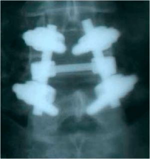 Рис. 9 b. Ренгенограмма поясничного отдела позвоночника в боковой (a) и прямой (b) проекции. Транспедикулярная фиксация  L4-L5 позвонков титановой конструкцией, удалена дужка L4 позвонка.