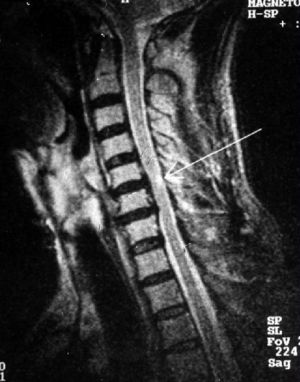 Рис.2. Магнитно-резонансная томография (МРТ) шейного отдела позвоночника в сагиттальной проекции. Стеноз позвоночного канала на уровне С5-С6, С6-С7 позвонков. Стрелкой указан очаг миелопатии округлой формы на уровне диска С5-С6 позвонков.