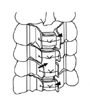 Рис.9. Схема ламинопластики  шейного отдела позвоночника по  типу «открытых окон» по Курокава.  Костные трансплантаты из подвздошной  кости установлены между разведенными дужками позвонков и фиксированы нитью.Стрелкой указан имплантированный трансплантат.