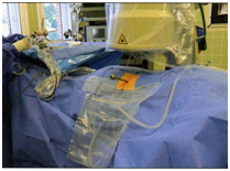 Рис.3.  Операция проводится под  контролем ЭОПа через прокол без разреза